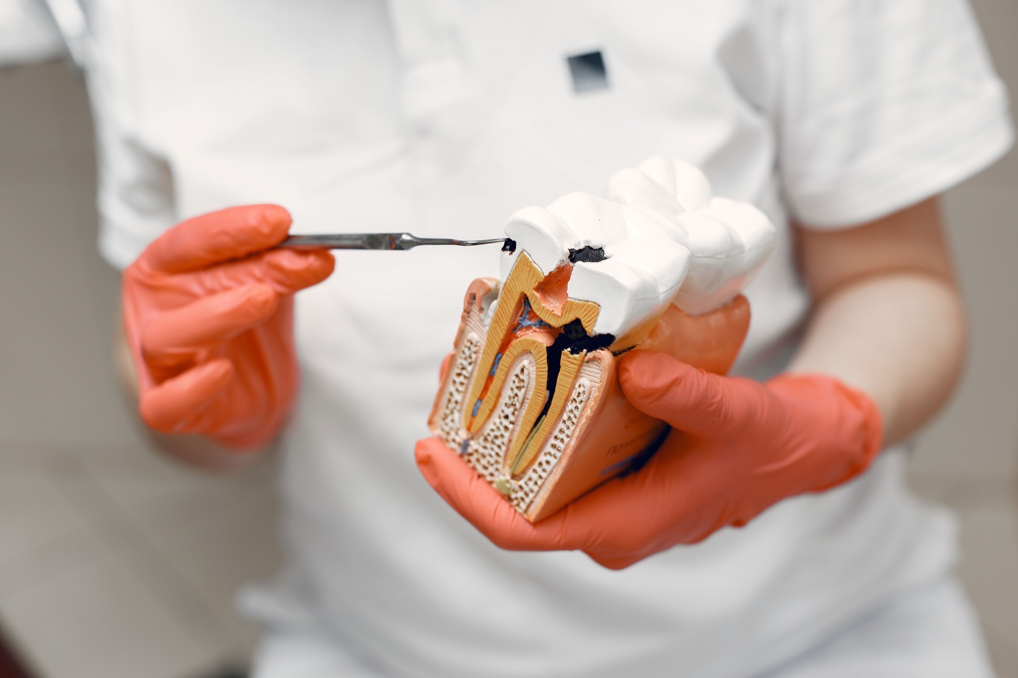Modello anatomico di dente con aree di carie