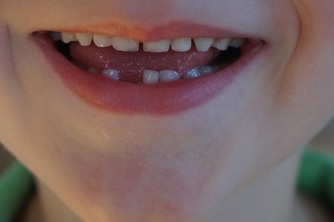 Sorriso di un bambino con uno spazio fra i denti, foto illustrativa