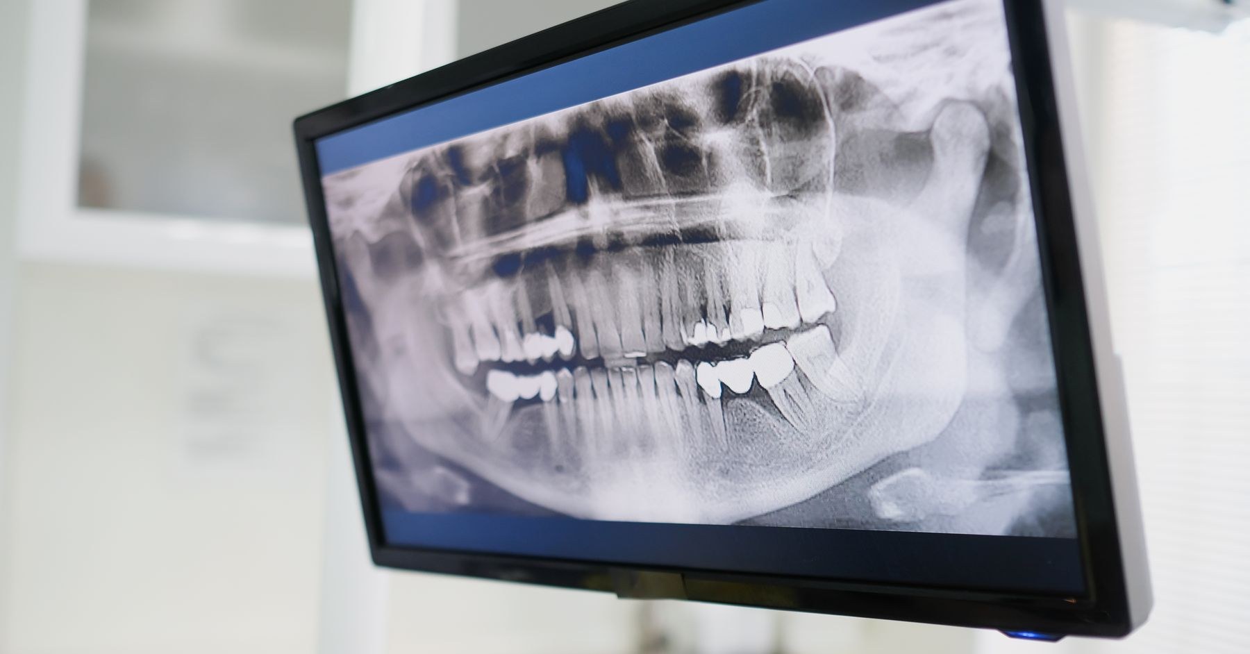 Radiografia panoramica dentale su un monitor, foto illustrativa