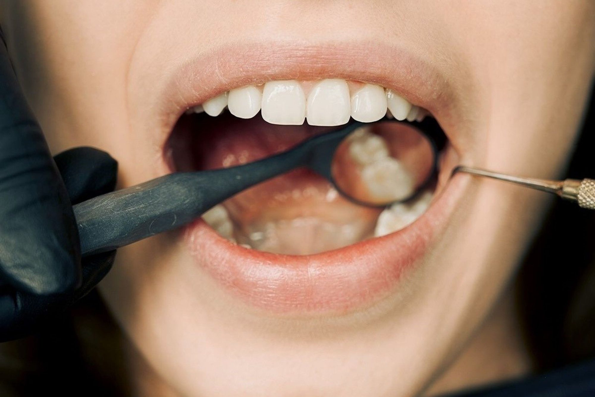 Esame odontoiatrico delle superfici dentali