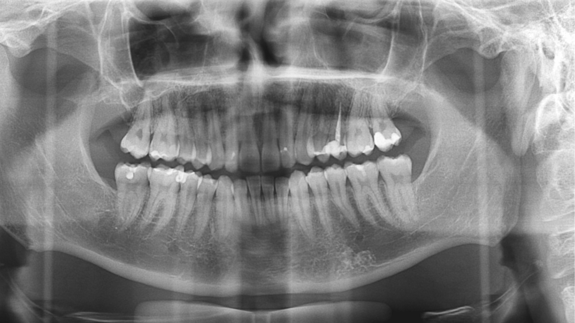Radiografia panoramica di una dentatura completa