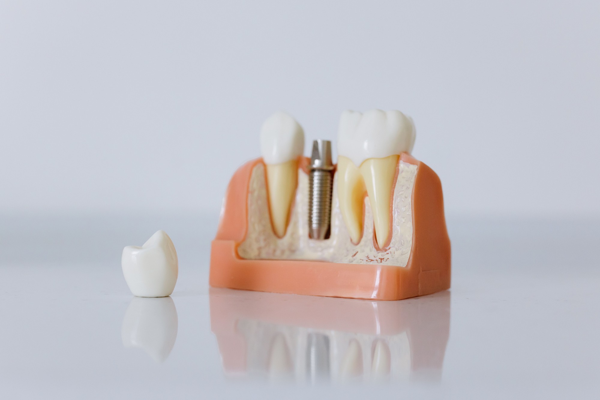 Modello anatomico con impianto dentale e tessuti di sostegno