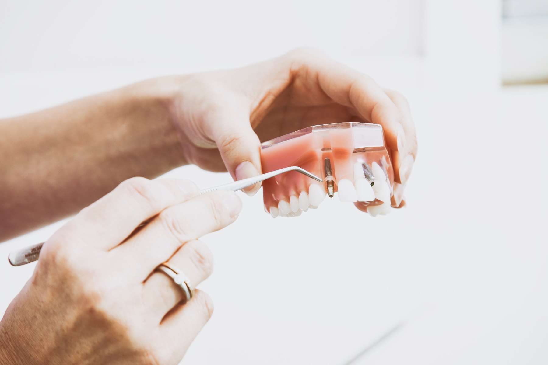 Modello anatomico di arcata dentale con impianti, indicati da una sonda odontoiatrica